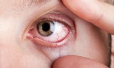 Göz kanlanması ve Nedenleri