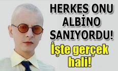 Pis Yedili Dizisinde PC Rolündeki Ahmet Yıldırım Gerçekten Albino Hastası Mı?