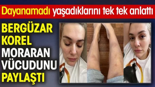 Bergüzar Korel moraran vücudunu paylaştı! Dayanamadı yaşadıklarını anlattı